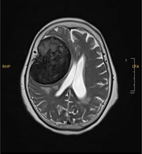Hình ảnh MRI ghi nhận khối u màng não vùng thái dương phải