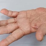 BỆNH GHẺ KHÔNG “XƯA CŨ”: CỤ BÀ MẮC CÁI GHẺ VÀ LÂY NHANH TRONG GIA ĐÌNH
