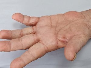Bàn tay bệnh nhân mắc cái ghẻ sau điều trị