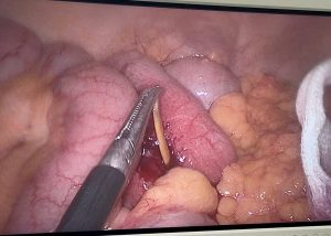 Dị vật sắc nhọn đâm thủng thành ruột non của bệnh nhân