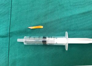 Dị vật sắc nhọn đã được các BS gấp ra ngoài