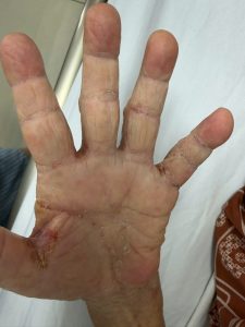 Kẽ ngón tay bệnh nhân xuất hiện dày sừng da, bỏng vảy trước khi điều trị