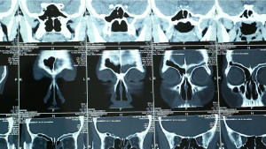 Phim MRI ca bệnh nhân viêm xoang do nấm