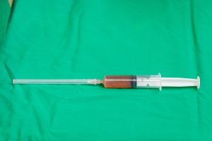 PRP sau khi được tách dùng để tiêm trong lúc ghép xương cho bệnh nhân hoại tử chỏm xương đùi