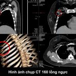 CỌNG KẼM 18CM “LẠC TRÔI” VÀO PHỔI KHIẾN NGƯỜI PHỤ NỮ KHÓ THỞ NGUY KỊCH