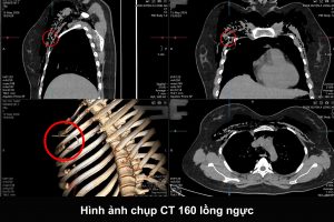 Hình ảnh CT của bệnh nhân nhập viện với tình trạng khó thở