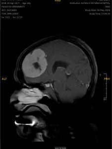 Hình ảnh phim MRI não (Khối u là phần trắng)