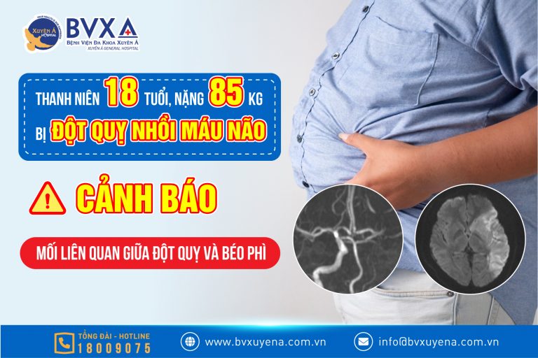 ĐỘT QUỴ NHỒI MÁU NÃO Ở THANH THIẾU NIÊN – MỐI LIÊN QUAN GIỮA ĐỘT QUỴ VÀ BÉO PHÌ