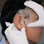 THANH SẮT RƠI TRÚNG MẶT NGƯỜI CÔNG NHÂN GÂY RA VẾT THƯƠNG NGHIÊM TRỌNG DÀI 12CM