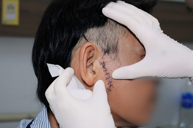 THANH SẮT RƠI TRÚNG MẶT NGƯỜI CÔNG NHÂN GÂY RA VẾT THƯƠNG NGHIÊM TRỌNG DÀI 12CM
