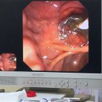 ĐẶT STENT KIM LOẠI ĐƯỜNG MẬT BẰNG KỸ THUẬT ERCP