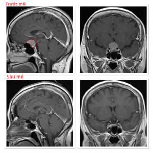 Hình ảnh MRI trước và sau mổ