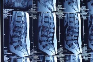 Hình ảnh MRI vị trí chén ép và áp xe cột sống