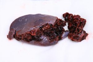 Lá lách dập nát sau tai nạn lao động chấn thương