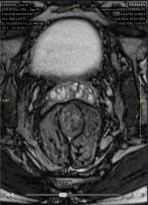 Hình ảnh CT khối ưng thư trực tràng thấp