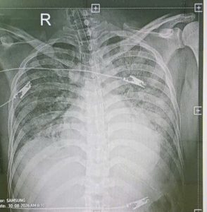 Hình ảnh CT phổi cho thấy tổn thương và phải đặt máy thở do suy hô hấp