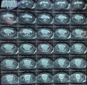 Hình ảnh MRI ghi nhận khối u tử cung của bệnh nhân