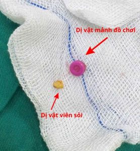 Hình ảnh dị vật được lấy ra