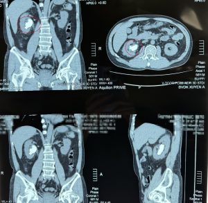Hình ảnh phim CT-scan của bệnh nhân phát hiện sỏi san hô