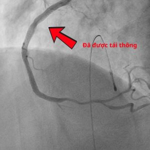 Hình ảnh mạch máu của bệnh nhân nhồi máu cơ tim cấp sau can thiệp