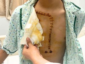 Vết mổ của bệnh nhân