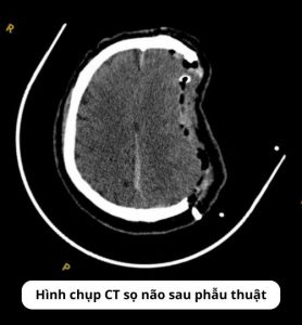 Ảnh CT sau phẫu thuật của bệnh nhân chấn thương sọ não sau cú đánh vào đầu