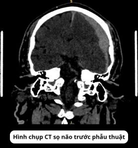 Ảnh CT trước phẫu thuật của bệnh nhân chấn thương sọ não sau cú đánh vào đầu