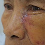 PHÁT HIỆN UNG THƯ DA TỪ VẾT LOÉT NHỎ TRÊN MẶT SUỐT NHIỀU NĂM