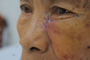 Hình ảnh bệnh nhân tái khám sau phẫu thuật điều trị ung thư da