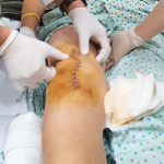 TỪ NGỒI XE LĂN ĐẾN TỰ ĐI LẠI SAU MỘT TUẦN NHỜ THAY KHỚP GỐI