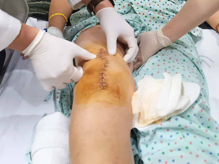 TỪ NGỒI XE LĂN ĐẾN TỰ ĐI LẠI SAU MỘT TUẦN NHỜ THAY KHỚP GỐI