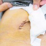 ĐAU BỤNG ÂM Ỉ, SỤT 10KG TRONG MỘT NĂM VÌ LOÉT ĐỘNG MẠCH CHỦ BỤNG