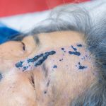 TỪ NHỮNG MỤN NƯỚC NHỎ ĐẾN BIẾN CHỨNG THẦN KINH DO ZONA