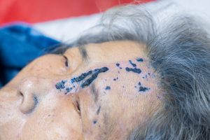 Vết Zona vùng da