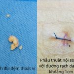 ĐAU LƯNG ĐỘT NGỘT, ĐAU LAN CHÂN: CẢNH GIÁC THOÁT VỊ ĐĨA ĐỆM CÓ MẢNH RỜI