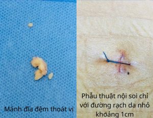 Mảnh đĩa đệm thoát vị và vết mổ của bệnh nhân đau lưng kéo dài