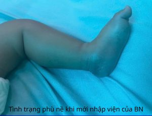 Hình ảnh bệnh nhi bị rắn lục đuôi đỏ cắn khi mới nhập viện
